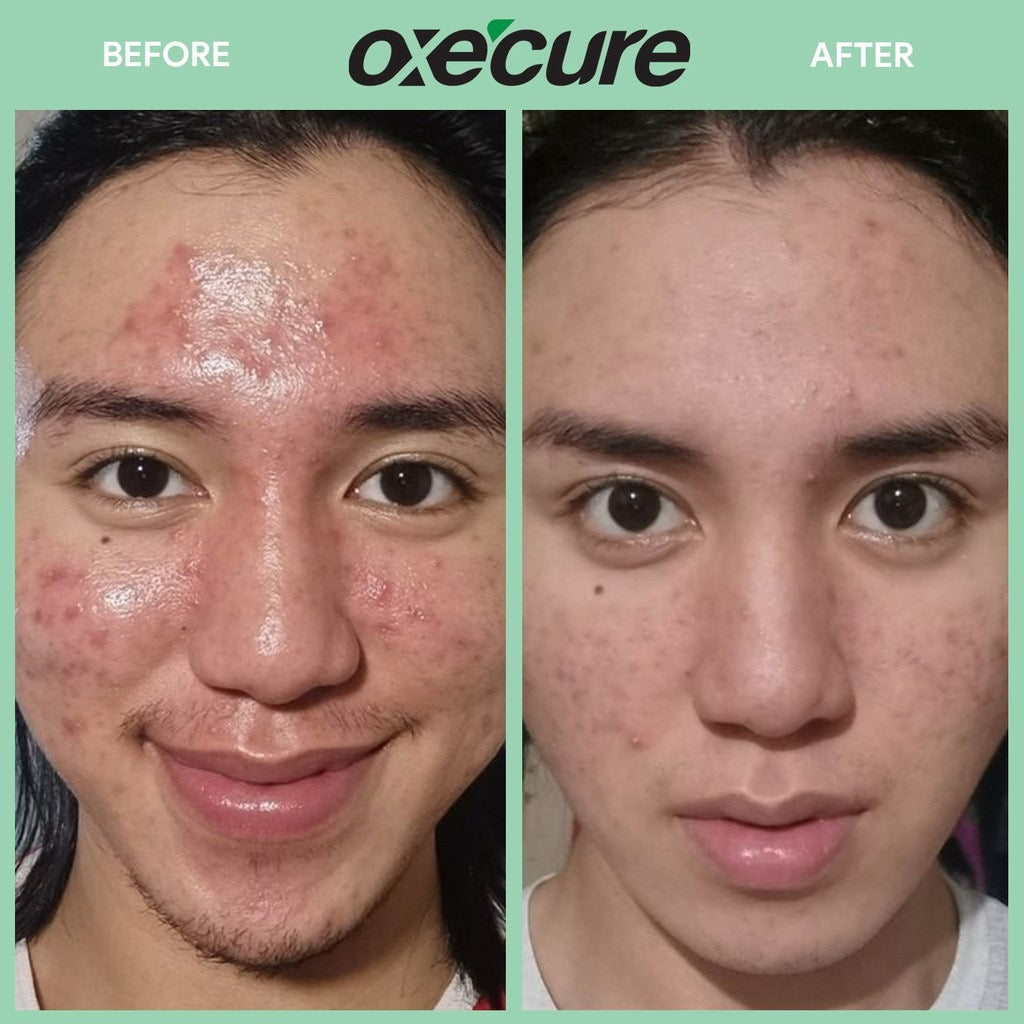 Oxecure Acne Defense Prebio Serum 20ml - LOBeauty | Shop Filipino Beauty Brands in the UAE